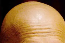 Konec plešatosti? Vědci vytvořili vlasy z kmenových buněk