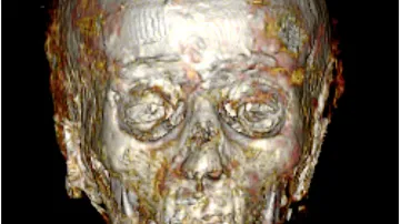 CT sken mumie „zlatého chlapce“
