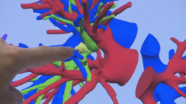 V pražském Motole odstranili nádor v plicích díky 3D modelu