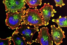 Vakcína na míru proti melanomu obstála ve studii „velmi působivě“