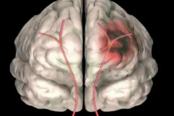 Brněnští vědci se spojili proti mozkové mrtvici. Chtějí vyvinout lepší diagnostiku i lék