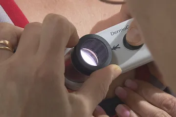 Stan proti melanomu začal letošní cestu za rozpoznáním nádorů na kůži. Stále jich přibývá, varují lékaři