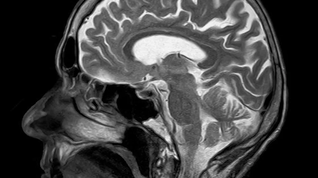 Lidský mozek na MRI