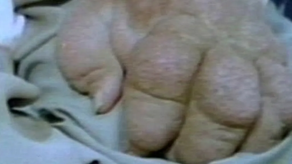 Onemocnění z ozáření