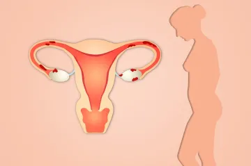 Na rakovinu dělohy umírají stovky žen ročně. Zásadní roli hraje obezita