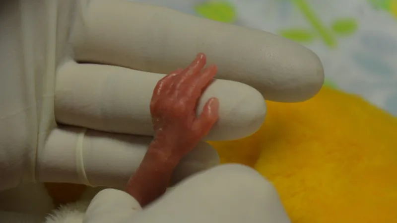 Holčička narozená s hmotností 322 gramů