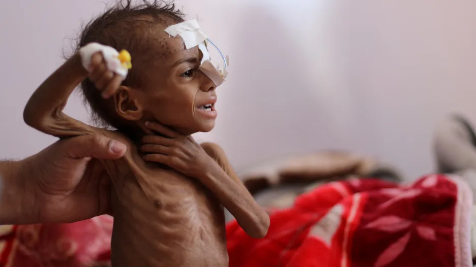 Podvyživené dítě v nemocnici v Saná