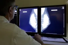 Britští vědci hlásí potenciální průlom ve výzkumu léčby rakoviny prsu