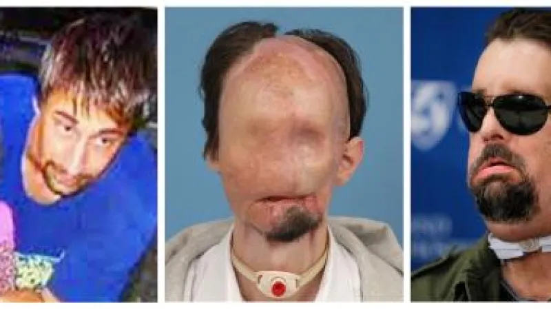 Dallas Wiens před nehodou, po nehodě a po transplantací obličeje