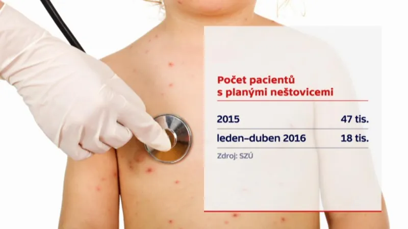 Počet pacientů s planými neštovicemi