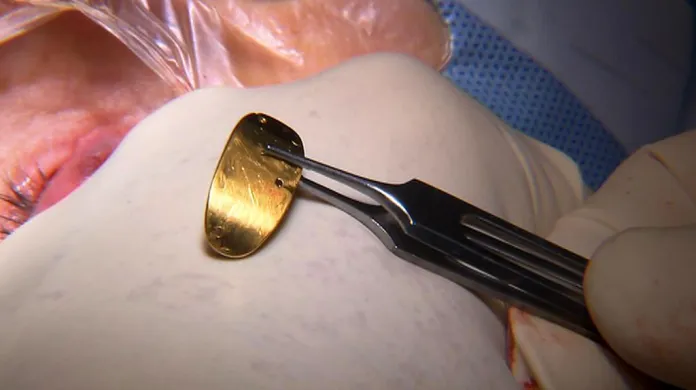 Zlatý implantát pomáhá svou vahou oko dovřít