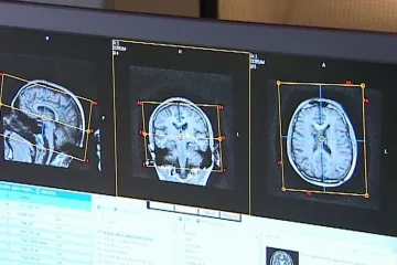 Roztroušená skleróza - diagnózu slyší tisíc lidí každý rok