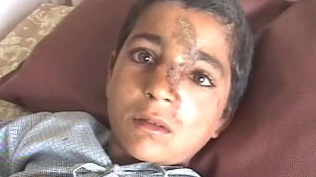 Zraněný afghánský chlapec