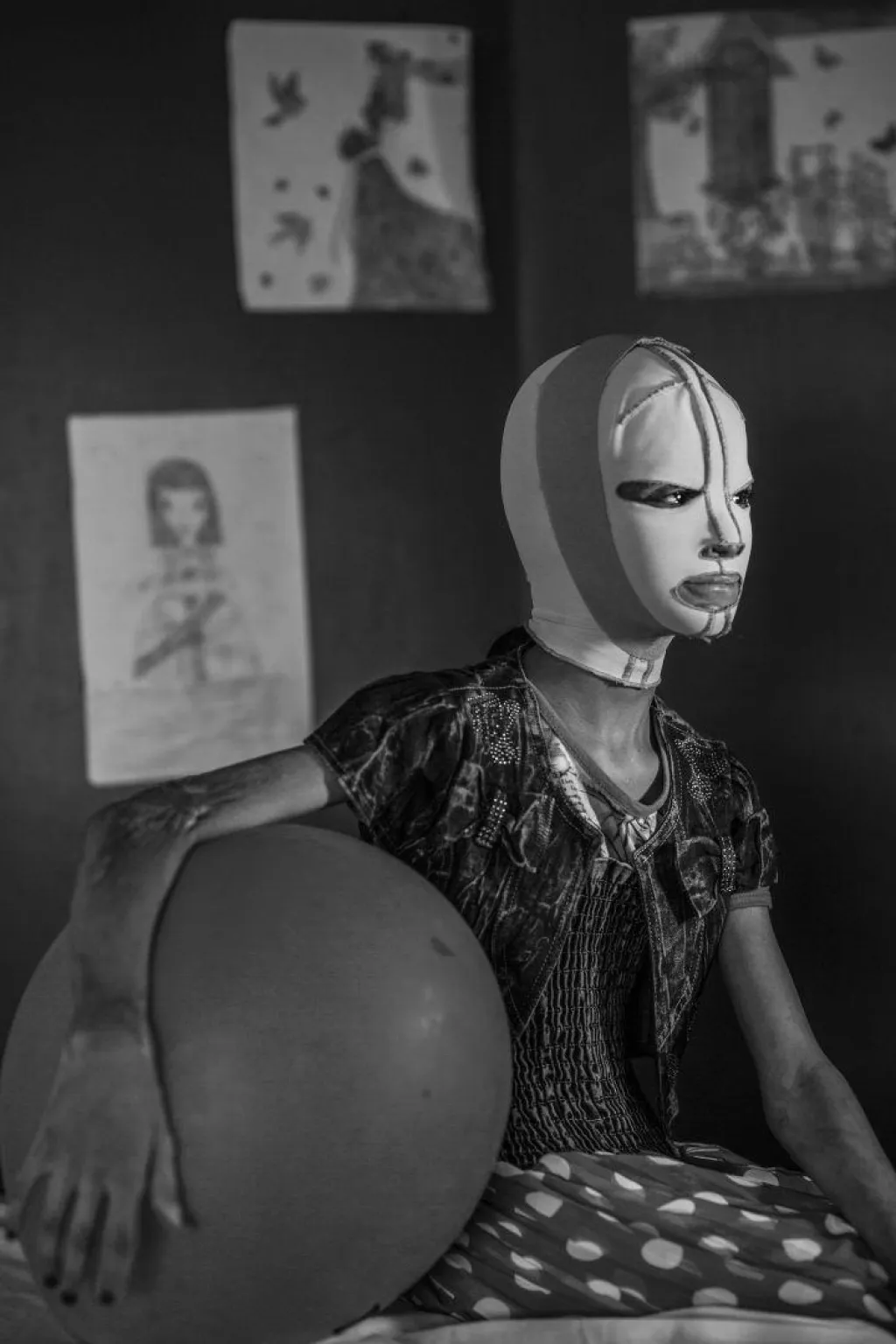 Druhá cena v kategorii Lidé. Dívka jménem Manal (11 let) přežila explozi rakety v íráckém městě Kirkuk. Po rozsáhlé plastické operaci obličeje v jordánské nemocnici musí teď nosit na několik hodin denně ochranou masku na tváři.