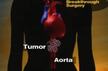 Lékaři provedli unikátní operaci - aby odstranili nádor, transplantovali několik orgánů