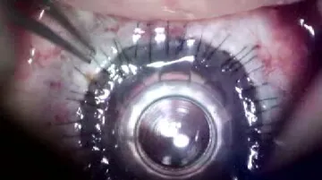 Operace oční rohovky