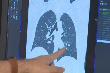 Jako suchý zip. Příznaky idiopatické plicní fibrózy by lidé neměli zaměňovat s následky po covidu