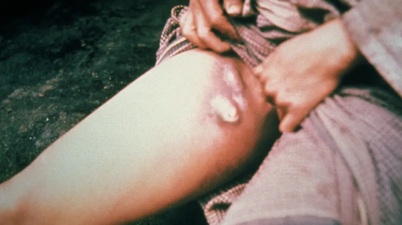 Typické projevy dýmějového moru