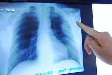 Lék proti rakovině plic má skvělé výsledky, oznámili američtí lékaři. Zachránil 51 procent pacientů