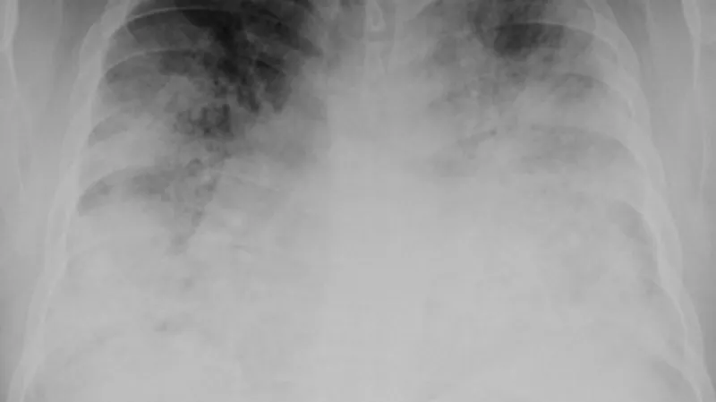 Plíce zasažené legionářskou nemocí
