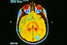 Nádorů mozku v Česku přibývá, lékaři musí někdy operovat pacienta při vědomí