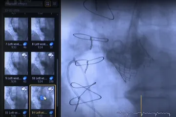 Díky nové technologii má při lékařských zákrocích stačit méně radiace