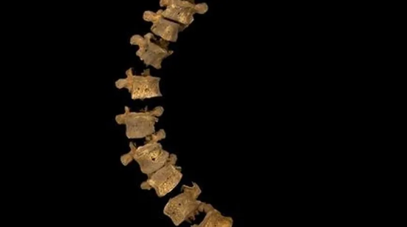 Nalezené ostatky potvrzují skoliozu Richarda III.