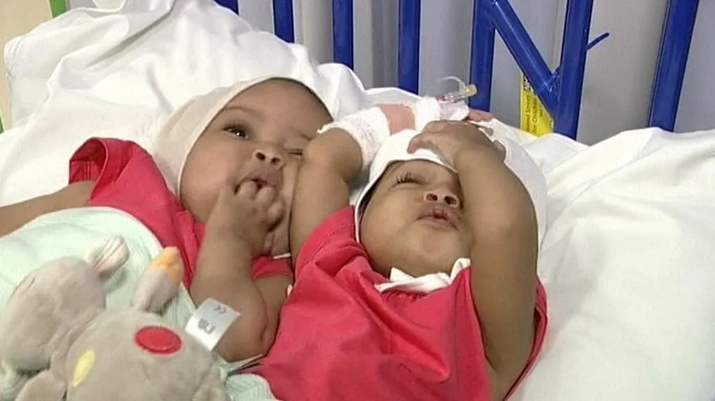 Oddělená siamská dvojčta