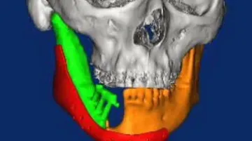 Zobrazení lebky s implantátem