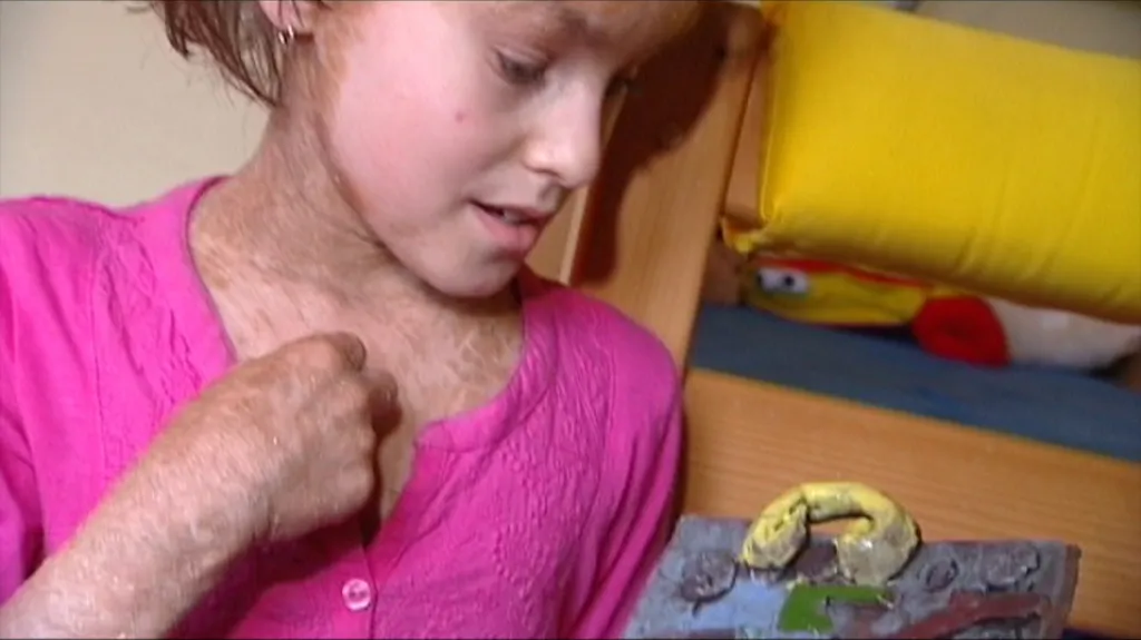 Ichtyóza - málo známé onemocnění kůže