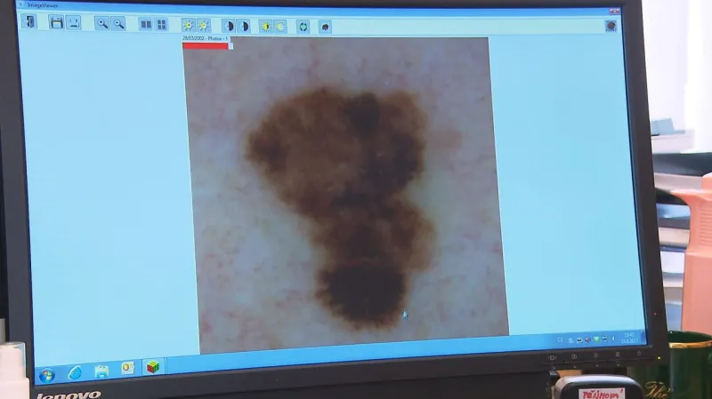 Melanom je typický hlavně svými nepravidelnostmi