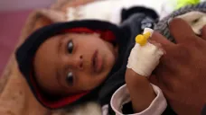 Dítě s malárií v Jemenu