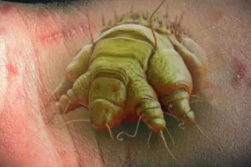 Hygieniky trápí rostoucí výskyt svrabu