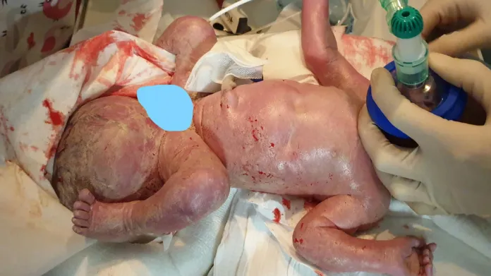 Dítě po narození, nádor v levé části
