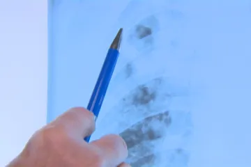 V Plzni roste počet cizinců, kteří onemocněli tuberkulózou