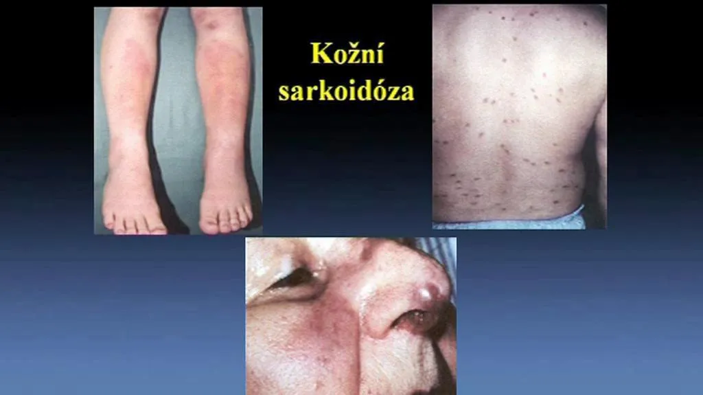 Příznaky kožní sarkoidózy
