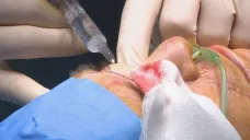 Rekonstrukce nosu v nemocnici v Brně