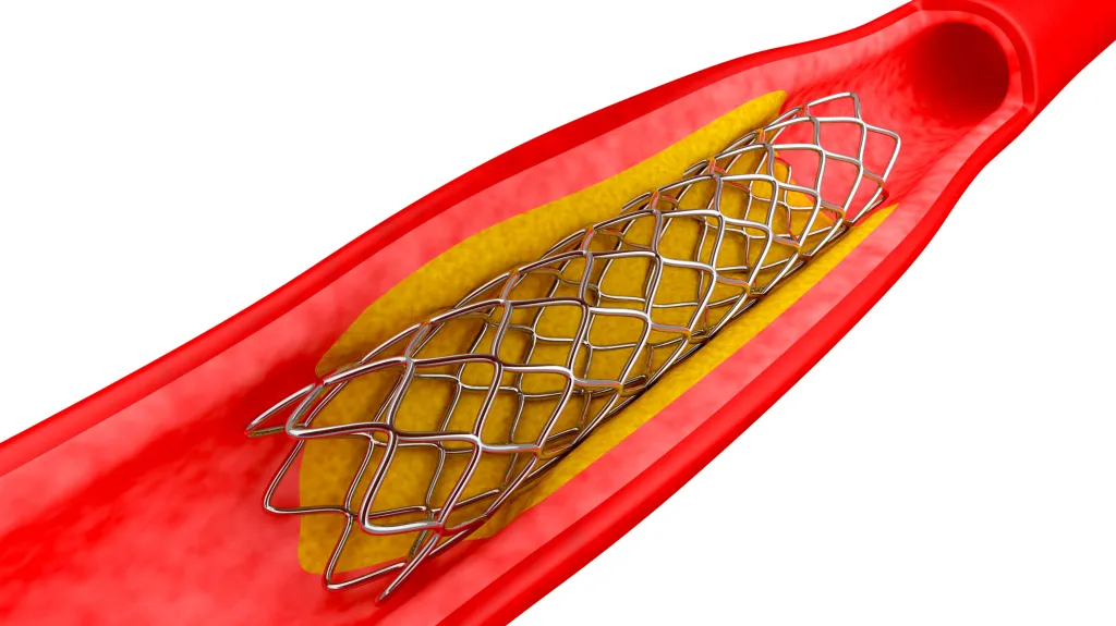 Stent