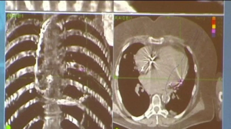 CyberKnife můžeme využít i v kardiochirurgii