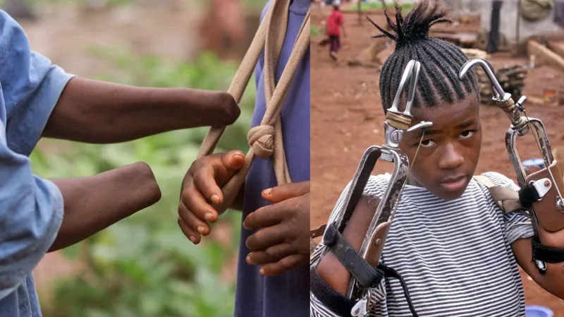 Oběti konfliktu v Sieře Leone