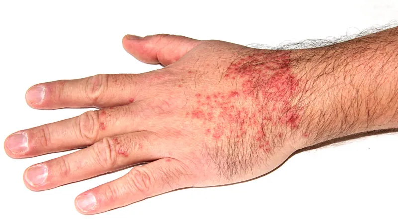 Cerkáriová dermatitida vyvolaná druhem Trichobilharzia szidati