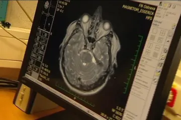 Na Ostravsku přibývá cévních mozkových příhod