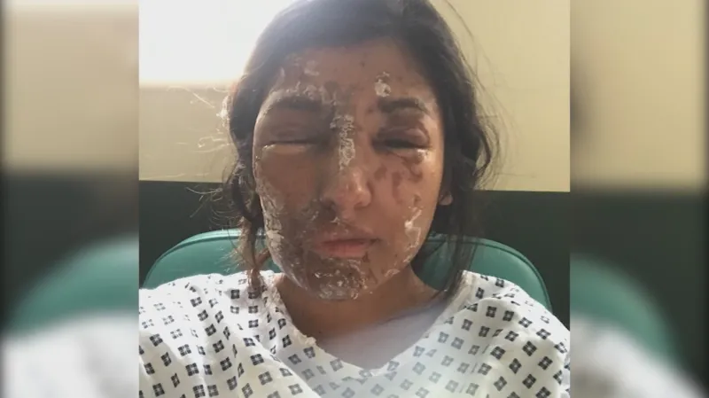 Oběť útoku kyselinou