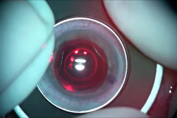 Bleskový zákrok. Moderní laser v Ostravě urychluje operaci šedého zákalu
