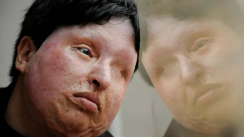 Íránka oslepená po útoku kyselinou