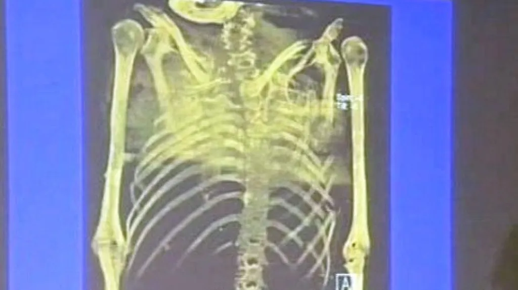 Rentgen ostatků generála Sikorského