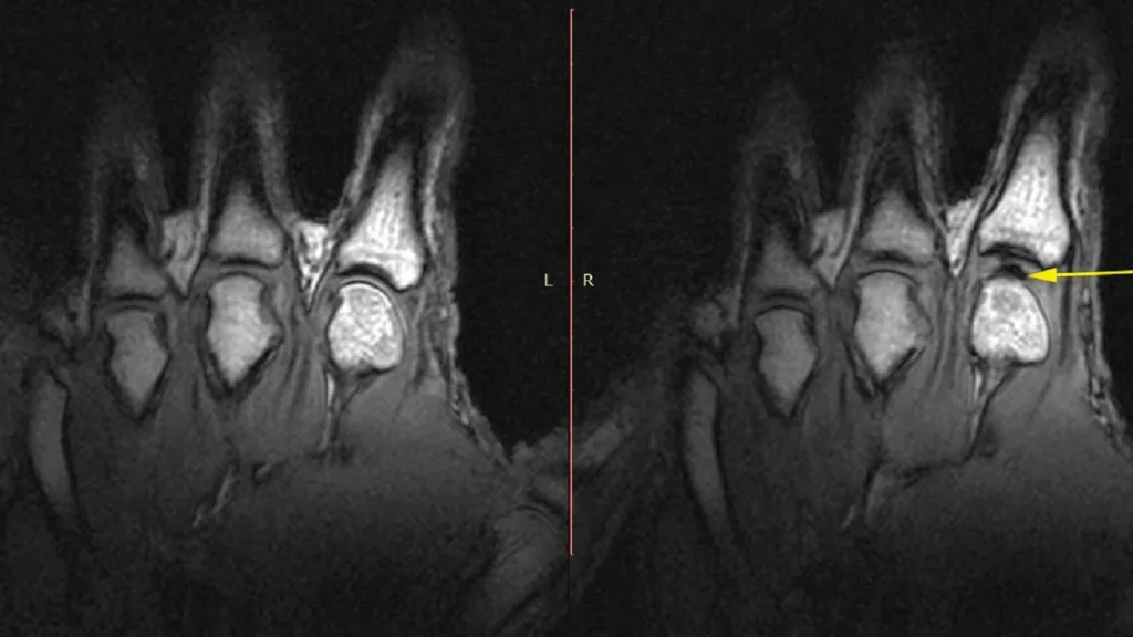 MRI sken křupajících prstů