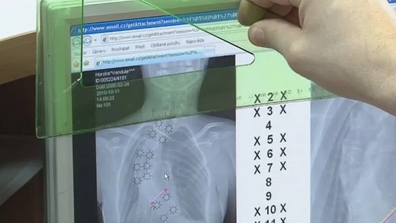 Vendulka trpěla velmi vážnou skoliozou