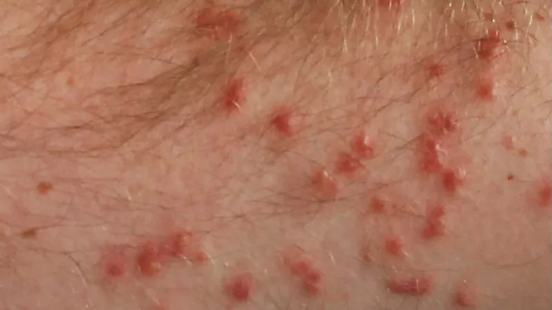 Vyrážka po koupání způsobená parazitem