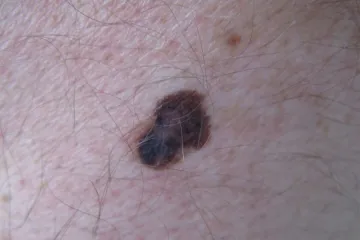 Muži s vysokou mírou testosteronu mohou mít větší riziko vzniku melanomu, domnívají se vědci